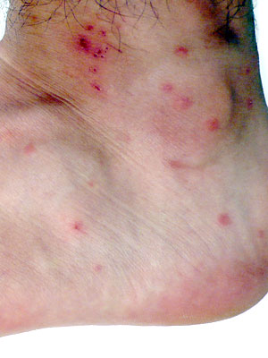 mite bites mite bites do not usually spread disease but