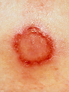 photogallery_how_to_identify_common_bug_bites_04_full
