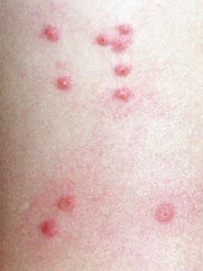 photogallery_how_to_identify_common_bug_bites_07_full