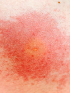 photogallery_how_to_identify_common_bug_bites_08_full