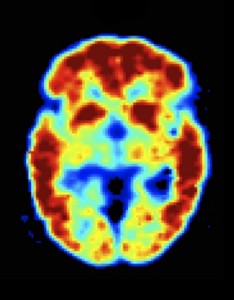 PET-scan-of-brain-234x300
